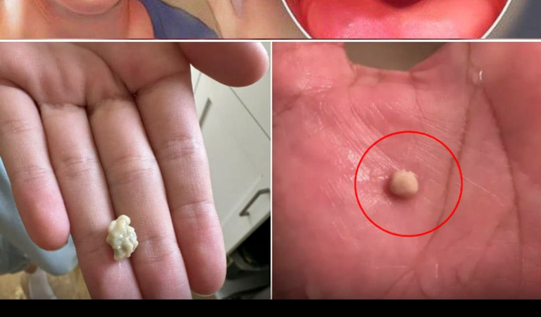 Here’s what you need to know about tonsil stones